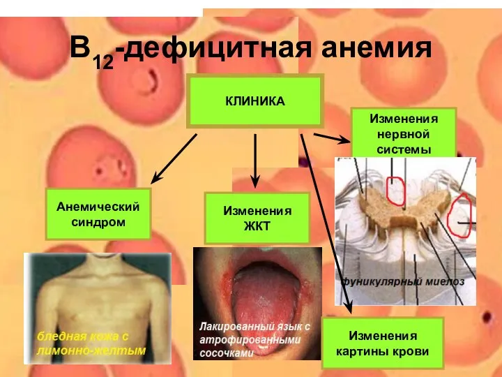 В12-дефицитная анемия КЛИНИКА Анемический синдром Изменения ЖКТ Изменения нервной системы Изменения картины крови