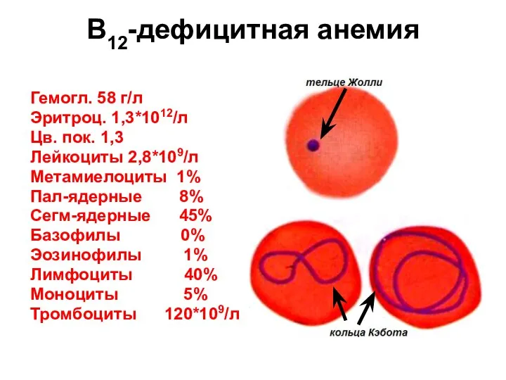 В12-дефицитная анемия Гемогл. 58 г/л Эритроц. 1,3*1012/л Цв. пок. 1,3 Лейкоциты