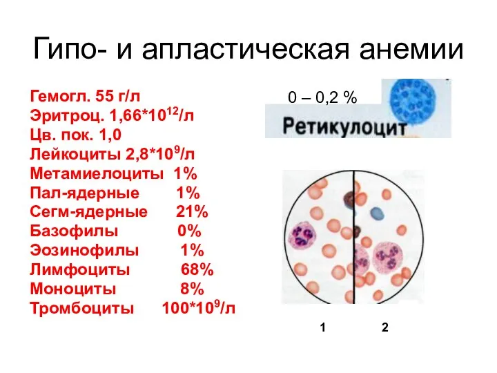 Гипо- и апластическая анемии Гемогл. 55 г/л Эритроц. 1,66*1012/л Цв. пок.