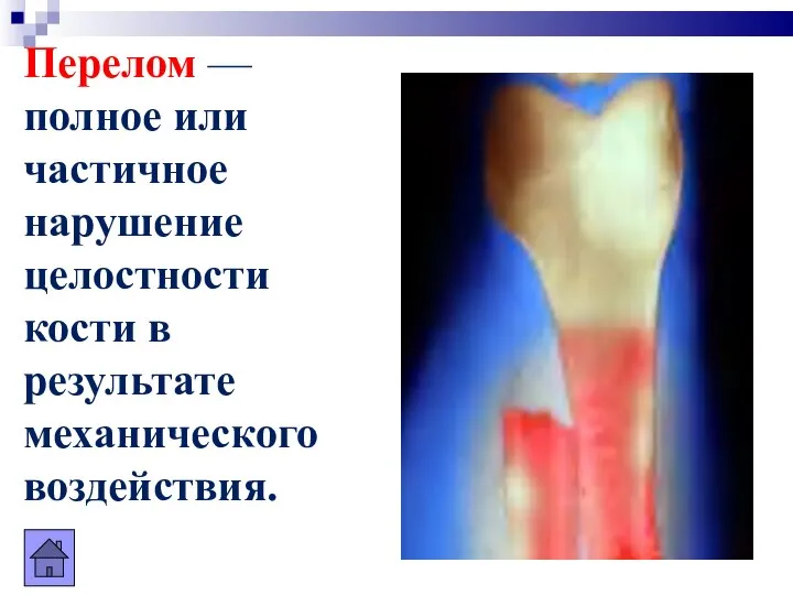 Перелом — полное или частичное нарушение целостности кости в результате механического воздействия.