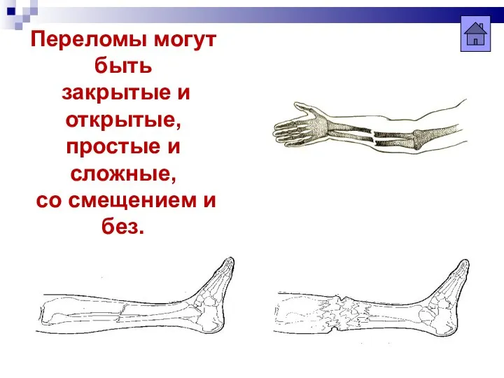 Переломы могут быть закрытые и открытые, простые и сложные, со смещением и без.