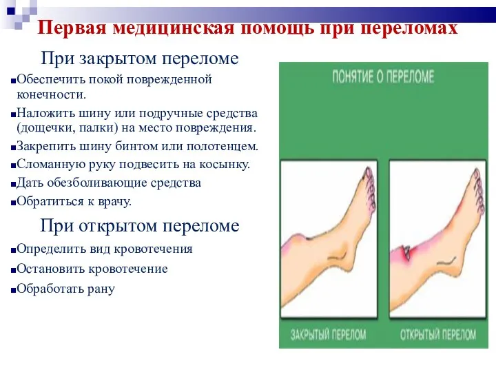 Первая медицинская помощь при переломах При закрытом переломе Обеспечить покой поврежденной