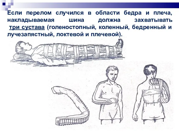 Если перелом случился в области бедра и плеча, накладываемая шина должна