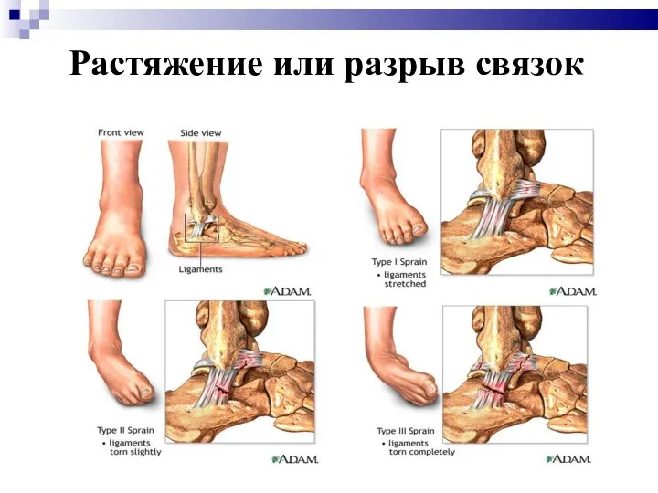 Растяжение или разрыв связок