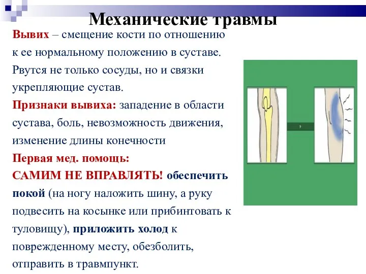 Механические травмы Вывих – смещение кости по отношению к ее нормальному