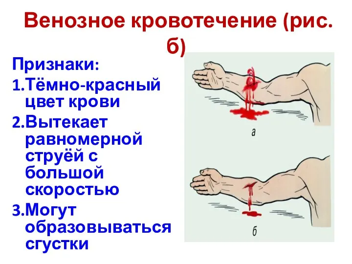 Венозное кровотечение (рис.б) Признаки: 1.Тёмно-красный цвет крови 2.Вытекает равномерной струёй с большой скоростью 3.Могут образовываться сгустки