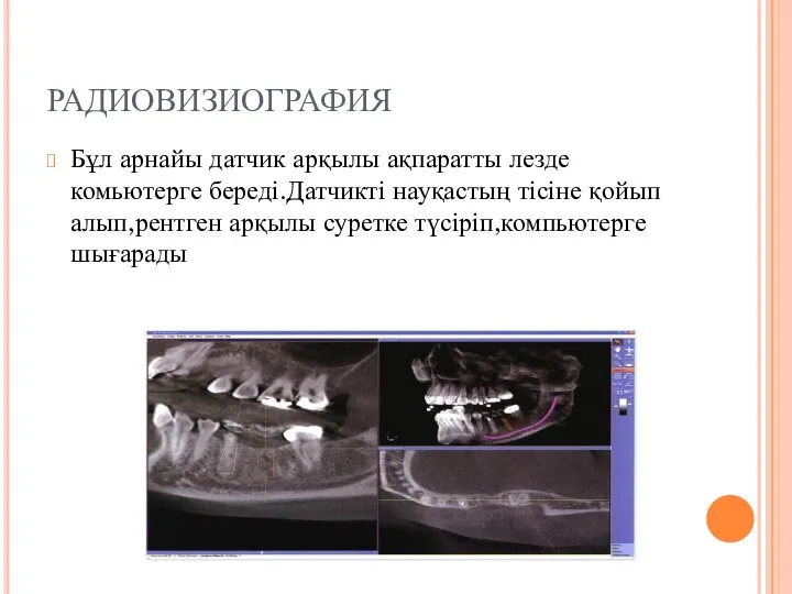 РАДИОВИЗИОГРАФИЯ Бұл арнайы датчик арқылы ақпаратты лезде комьютерге береді.Датчикті науқастың тісіне