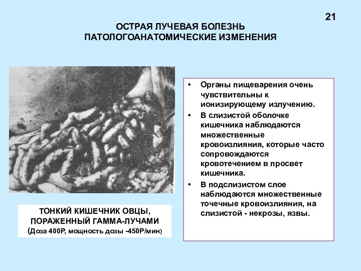 ОСТРАЯ ЛУЧЕВАЯ БОЛЕЗНЬ ПАТОЛОГОАНАТОМИЧЕСКИЕ ИЗМЕНЕНИЯ Органы пищеварения очень чувствительны к ионизирующему