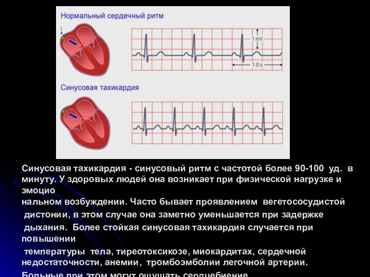 Синусовая тахикардия - синусовый ритм с частотой более 90-100 уд. в