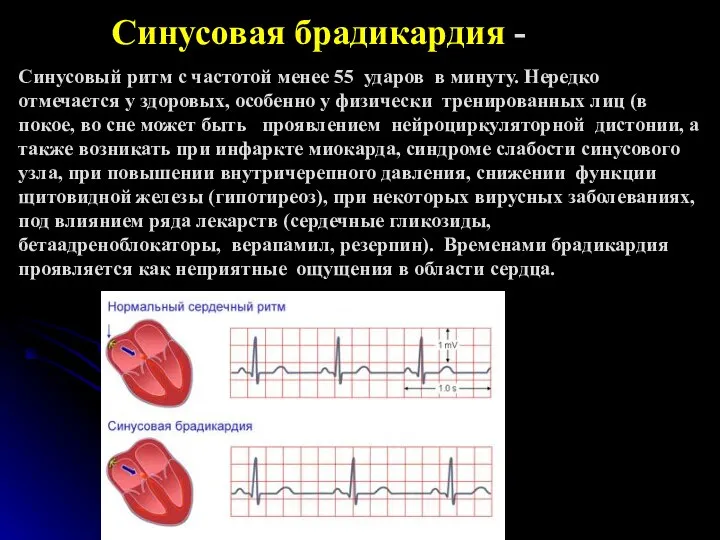 Синусовая брадикардия - Синусовый ритм с частотой менее 55 ударов в