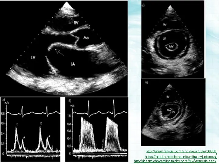 http://learnechocardiography.com/MvStenosis.aspx https://health-medicine.info/mitralnyj-stenoz/ http://www.mif-ua.com/archive/article/38886