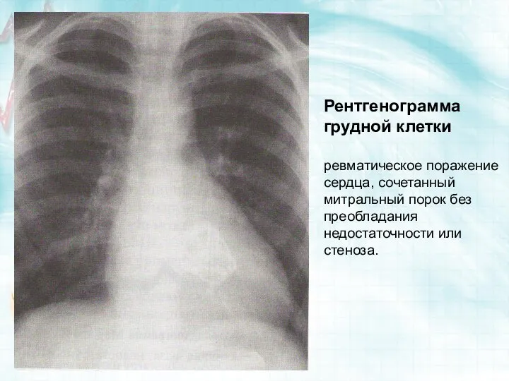 Рентгенограмма грудной клетки ревматическое поражение сердца, сочетанный митральный порок без преобладания недостаточности или стеноза.