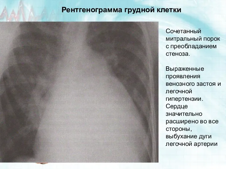 Сочетанный митральный порок с преобладанием стеноза. Выраженные проявления венозного застоя и