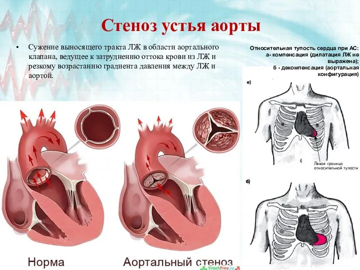 Стеноз устья аорты Сужение выносящего тракта ЛЖ в области аортального клапана,