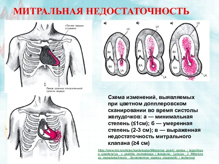 МИТРАЛЬНАЯ НЕДОСТАТОЧНОСТЬ Схема изменений, выявляемых при цветном допплеровском сканировании во время