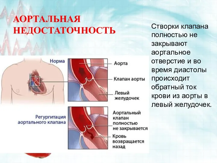 АОРТАЛЬНАЯ НЕДОСТАТОЧНОСТЬ Створки клапана полностью не закрывают аортальное отверстие и во