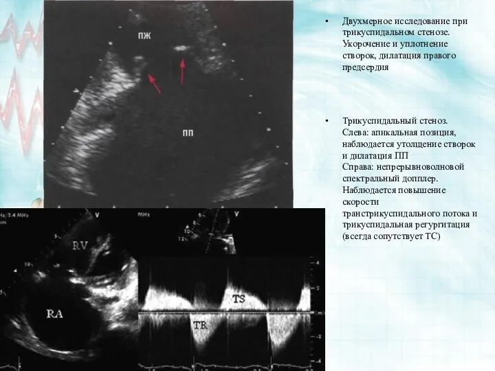 Двухмерное исследование при трикуспидальном стенозе. Укорочение и уплотнение створок, дилатация пра­вого