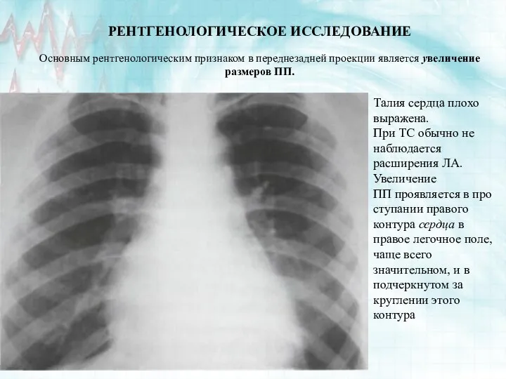 РЕНТГЕНОЛОГИЧЕСКОЕ ИССЛЕДОВАНИЕ Основным рентгенологическим признаком в переднезадней проекции является увеличение размеров