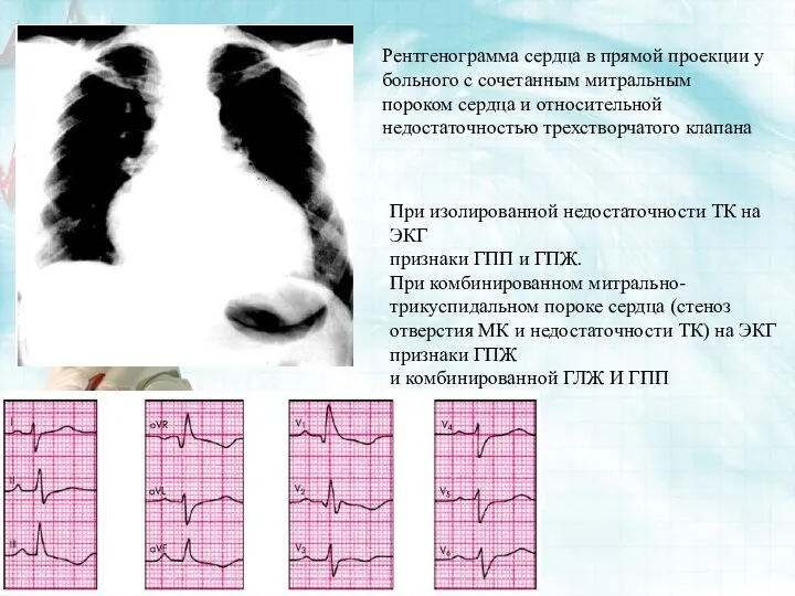 При изолированной недостаточности ТК на ЭКГ признаки ГПП и ГПЖ. При