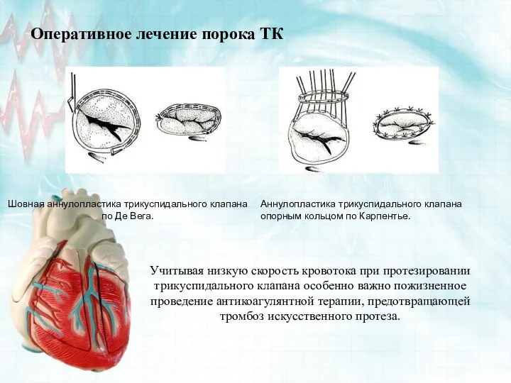 Оперативное лечение порока ТК Шовная аннулопластика трикуспидального клапана по Де Вега.