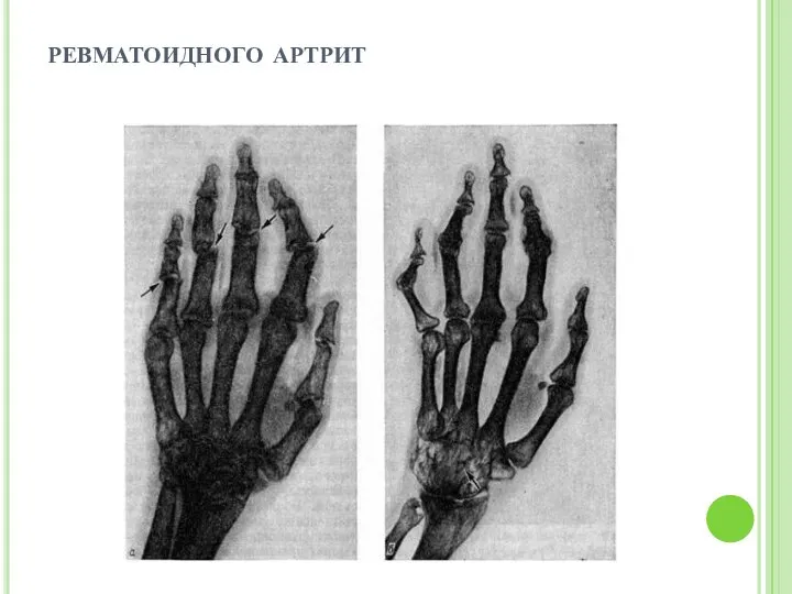 ревматоидного артрит