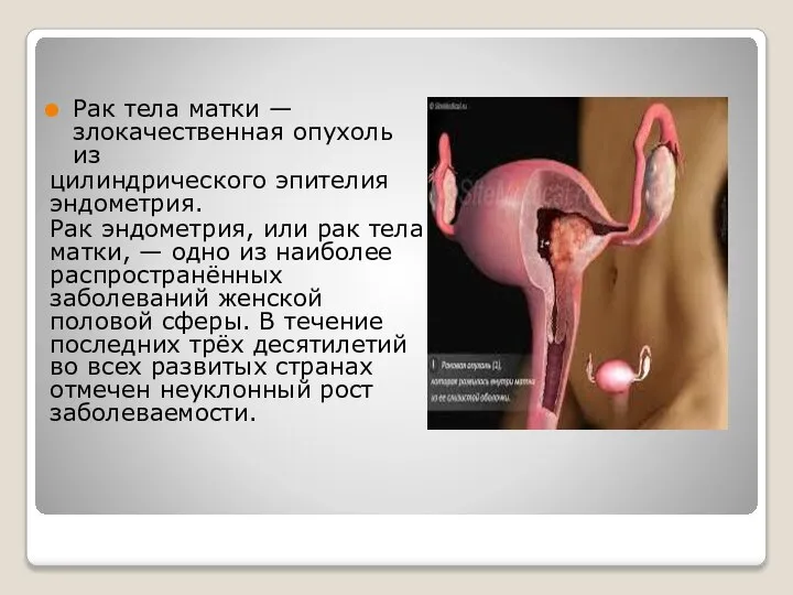 Рак тела матки — злокачественная опухоль из цилиндрического эпителия эндометрия. Рак