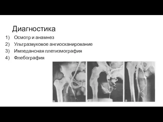 Диагностика Осмотр и анамнез Ультразвуковое ангиосканирование Импедансная плетизмография Флебография