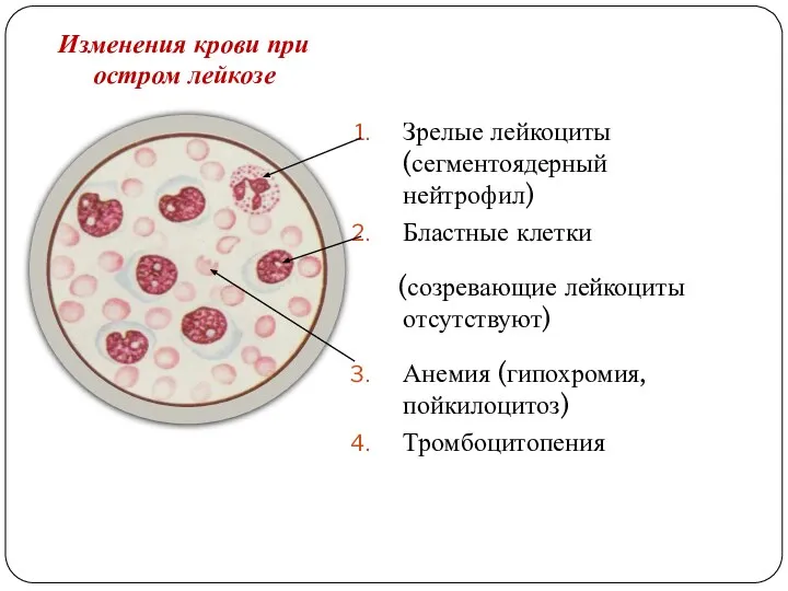 Изменения крови при остром лейкозе Зрелые лейкоциты (сегментоядерный нейтрофил) Бластные клетки