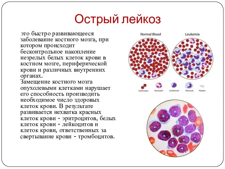 Острый лейкоз это быстро развивающееся заболевание костного мозга, при котором происходит