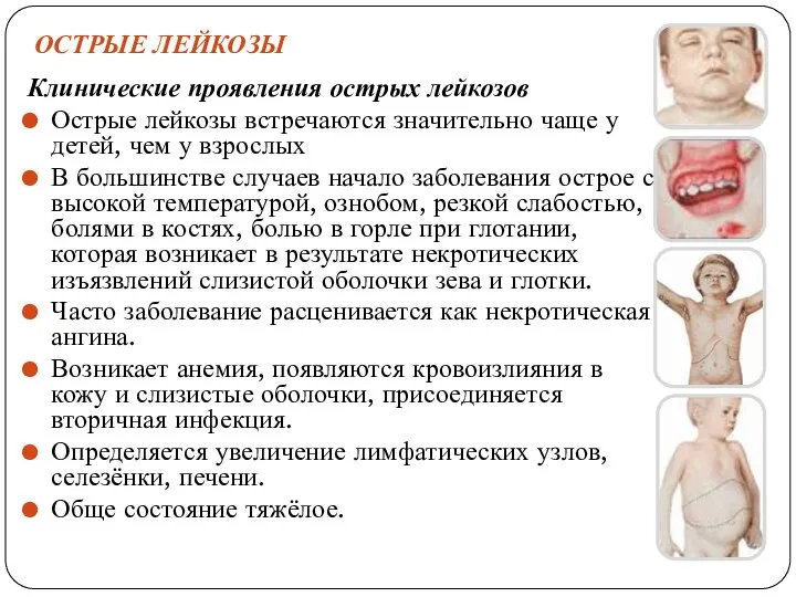 ОСТРЫЕ ЛЕЙКОЗЫ Клинические проявления острых лейкозов Острые лейкозы встречаются значительно чаще