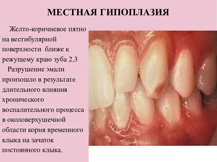 МЕСТНАЯ ГИПОПЛАЗИЯ Желто-коричневое пятно на вестибулярной поверхности ближе к режущему краю