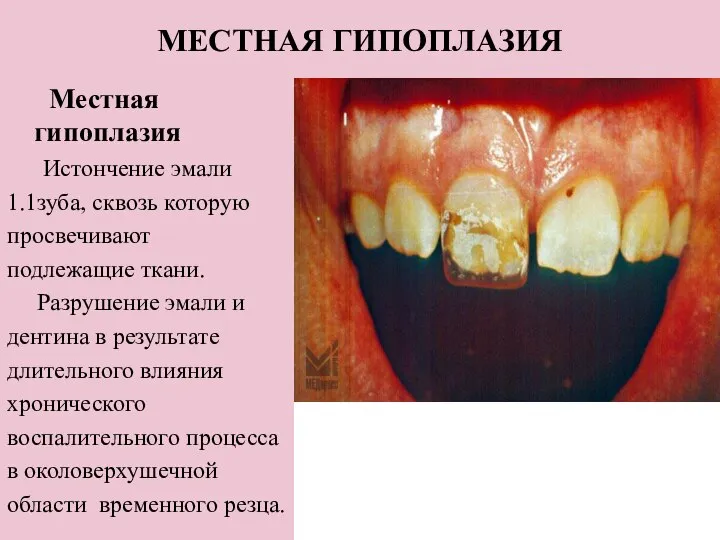 МЕСТНАЯ ГИПОПЛАЗИЯ Местная гипоплазия Истончение эмали 1.1зуба, сквозь которую просвечивают подлежащие