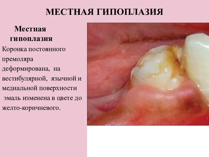 МЕСТНАЯ ГИПОПЛАЗИЯ Местная гипоплазия Коронка постоянного премоляра деформирована, на вестибулярной, язычной