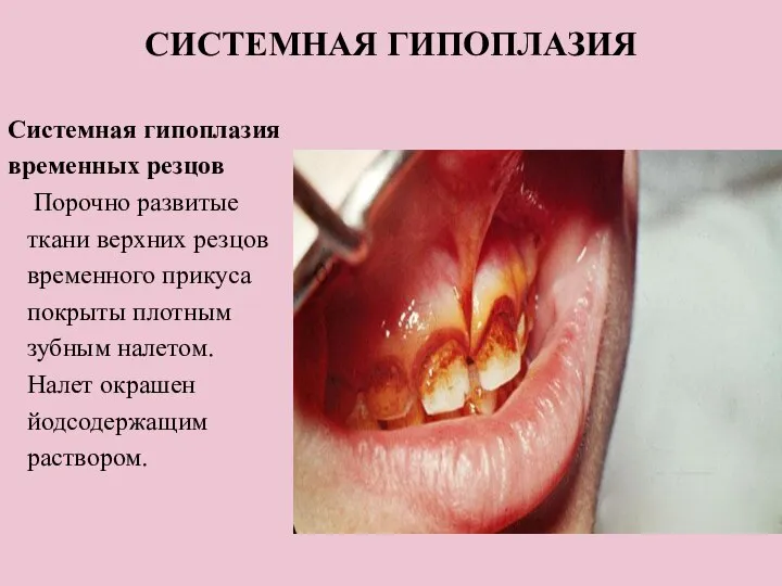 СИСТЕМНАЯ ГИПОПЛАЗИЯ Системная гипоплазия временных резцов Порочно развитые ткани верхних резцов