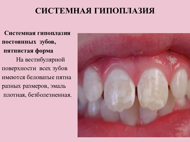 СИСТЕМНАЯ ГИПОПЛАЗИЯ Системная гипоплазия постоянных зубов, пятнистая форма На вестибулярной поверхности