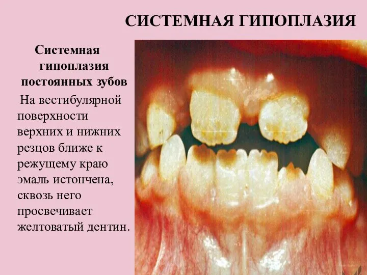 СИСТЕМНАЯ ГИПОПЛАЗИЯ Системная гипоплазия постоянных зубов На вестибулярной поверхности верхних и