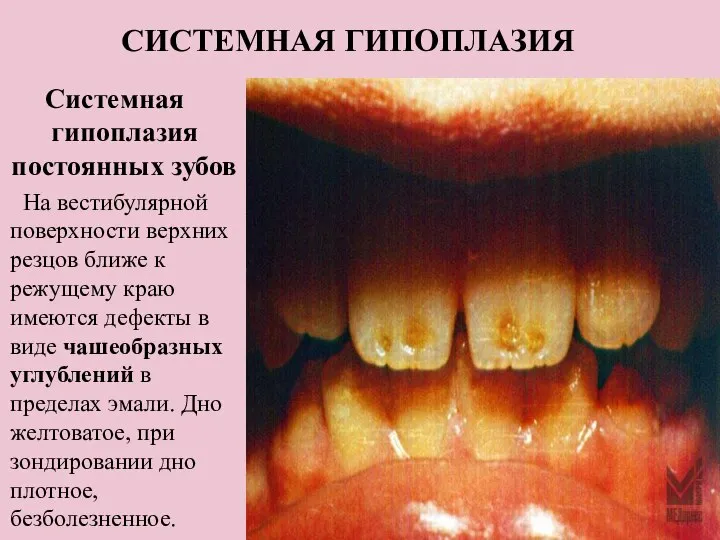 СИСТЕМНАЯ ГИПОПЛАЗИЯ Системная гипоплазия постоянных зубов На вестибулярной поверхности верхних резцов