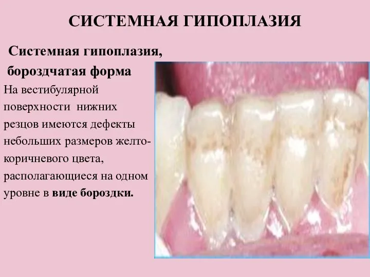 СИСТЕМНАЯ ГИПОПЛАЗИЯ Системная гипоплазия, бороздчатая форма На вестибулярной поверхности нижних резцов