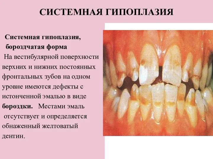 СИСТЕМНАЯ ГИПОПЛАЗИЯ Системная гипоплазия, бороздчатая форма На вестибулярной поверхности верхних и