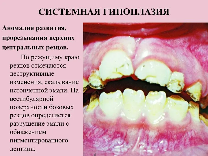 СИСТЕМНАЯ ГИПОПЛАЗИЯ Аномалия развития, прорезывания верхних центральных резцов. По режущиму краю