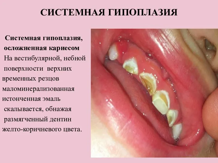 СИСТЕМНАЯ ГИПОПЛАЗИЯ Системная гипоплазия, осложненная кариесом На вестибулярной, небной поверхности верхних