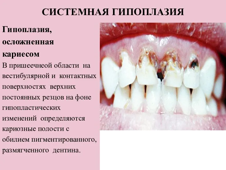 СИСТЕМНАЯ ГИПОПЛАЗИЯ Гипоплазия, осложненная кариесом В пришеечнеой области на вестибулярной и