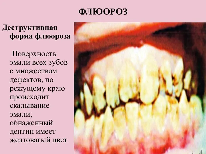 ФЛЮОРОЗ Деструктивная форма флюороза Поверхность эмали всех зубов с множеством дефектов,