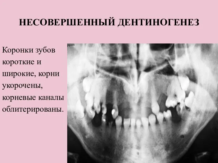 НЕСОВЕРШЕННЫЙ ДЕНТИНОГЕНЕЗ Коронки зубов короткие и широкие, корни укорочены, корневые каналы облитерированы.