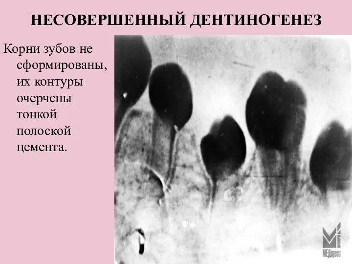 НЕСОВЕРШЕННЫЙ ДЕНТИНОГЕНЕЗ Корни зубов не сформированы,их контуры очерчены тонкой полоской цемента.