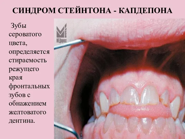 СИНДРОМ СТЕЙНТОНА - КАПДЕПОНА Зубы сероватого цвета, определяется стираемость режущего края