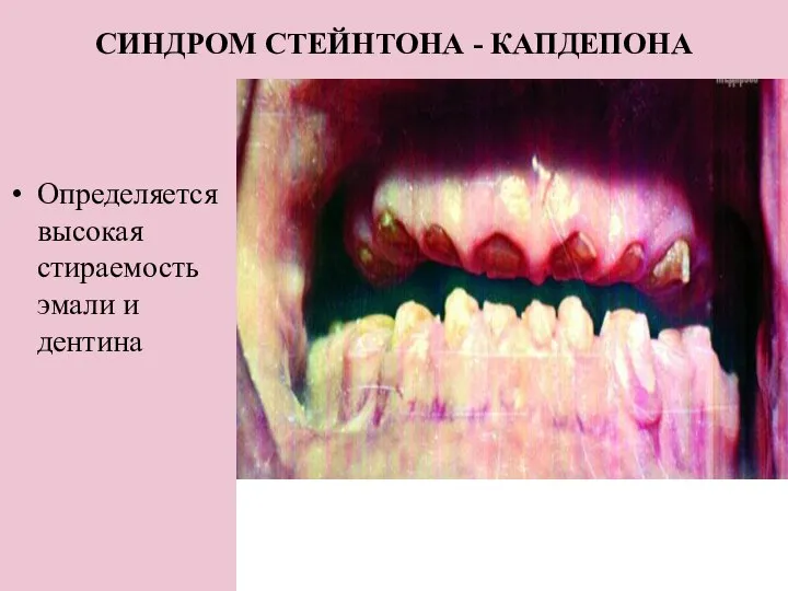 СИНДРОМ СТЕЙНТОНА - КАПДЕПОНА Определяется высокая стираемость эмали и дентина