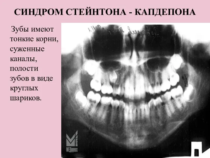 СИНДРОМ СТЕЙНТОНА - КАПДЕПОНА Зубы имеют тонкие корни, суженные каналы, полости зубов в виде круглых шариков.