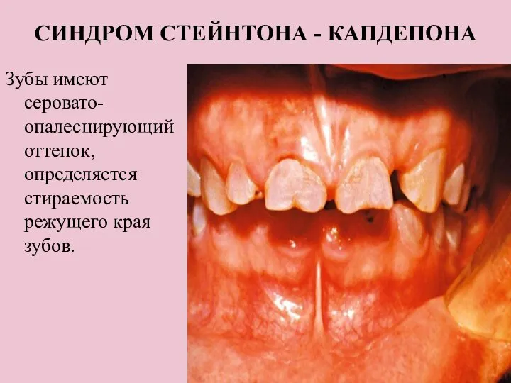 СИНДРОМ СТЕЙНТОНА - КАПДЕПОНА Зубы имеют серовато- опалесцирующий оттенок, определяется стираемость режущего края зубов.