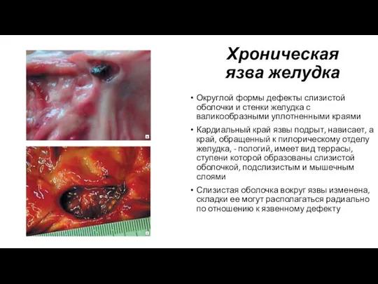 Хроническая язва желудка Округлой формы дефекты слизистой оболочки и стенки желудка